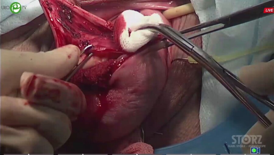 Каппушева Л.М. - Хирургическая коррекция тазового пролапса: задний компартмент из вагинального доступа