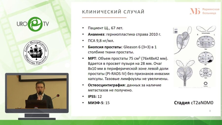 Ильин Д.М. - Робот-ассистированная простатэктомия при РП со средней долей больших размеров