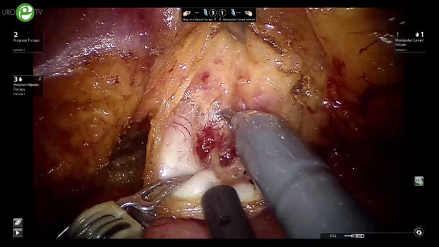 Фатих Атуг - Ретроградная нервосберегающая РПЭ (Роботическая операционная)