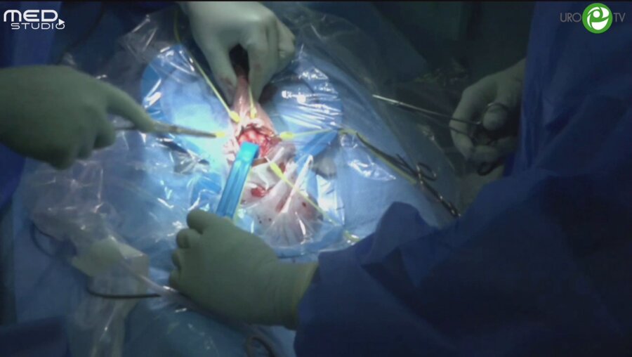 Муннарис Р. - Фаллопротезирование трехкомпонентным фаллопротезом Сoloplast Titan Touch через мошоночный доступ