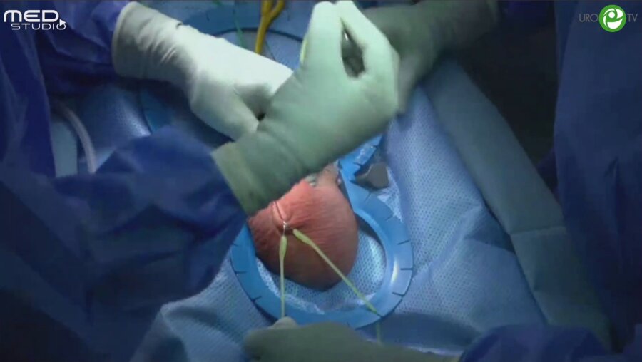 Ахвледиани Н.Д. - Фаллопротезирование трехкомпонентным фаллопротезом Сoloplast Titan Touch через подлобковый доступ