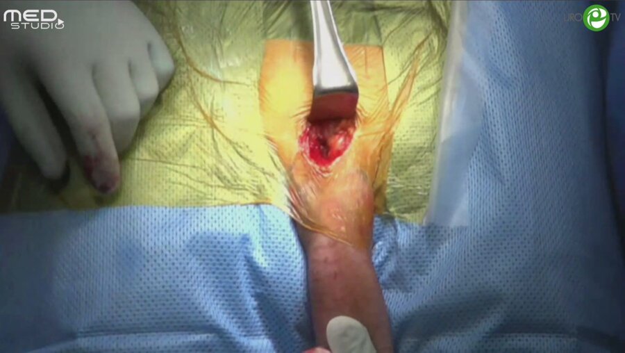 Валензуэла Р. - Фаллопротезирование трехкомпонентным фаллопротезом Сoloplast Titan Touch при тяжелом кавернозном фиброзе