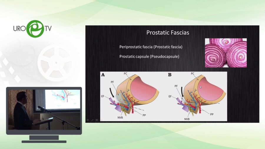 Фатих Атуг - Ретроградная нервосберешающая РПЭ