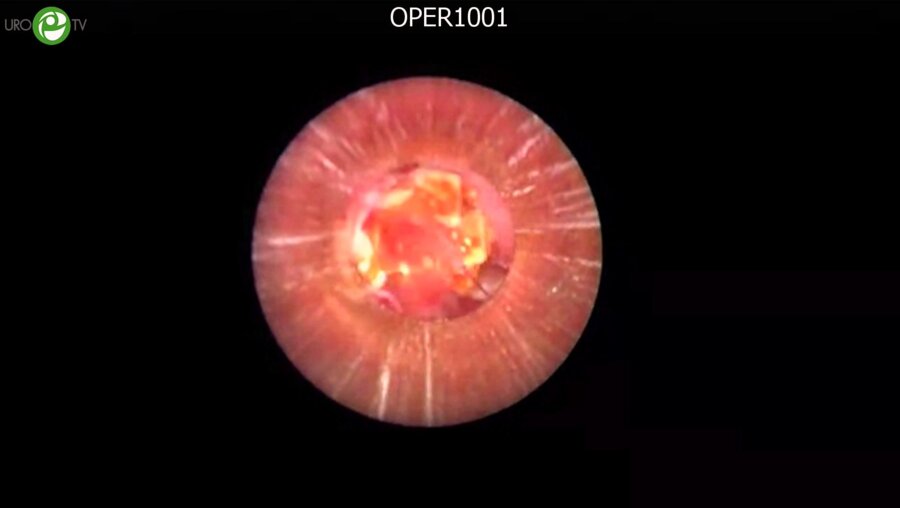 Артемов А.В. - Ретроградная интраренальная хирургия; Меринов Д.C. - Миниперкутанная нефролитолапаксия