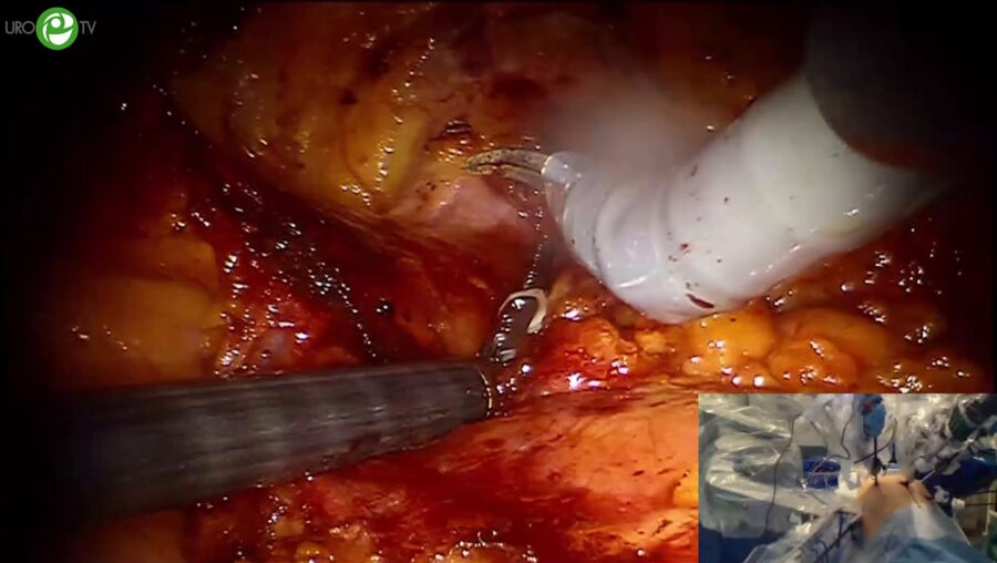 Абоян И.А. - Робот-ассистированная нервосберегающая простотэктомия. Боковой доступ