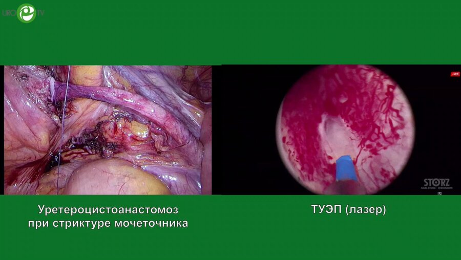 Севрюков Ф.А. - ТУЭП (лазер)