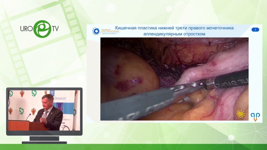 Санжаров А.Е. - Лапароскопическая реконструктивно-пластическая хирургия - урологические возможности тонкой кишки