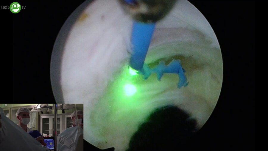 Топузов Т.М. - Лазерная энуклеация предстательной железы (HoLEP, ThuLEP)