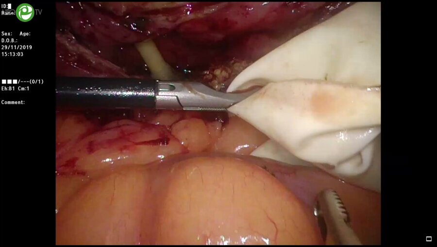 Лапароскопическая аденомэктомия