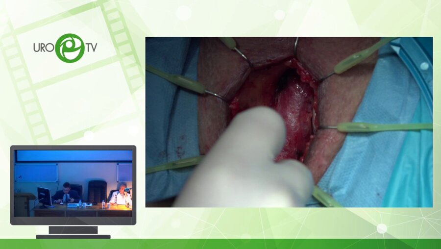 Анастомотическая пластика луковичного отдела уретры. Анастомотическая увеличивающая пластика луковичного отдела уретры