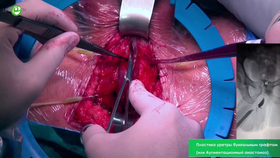 Пластика уретры буккальным графтом (или Аугментационный анастомоз)