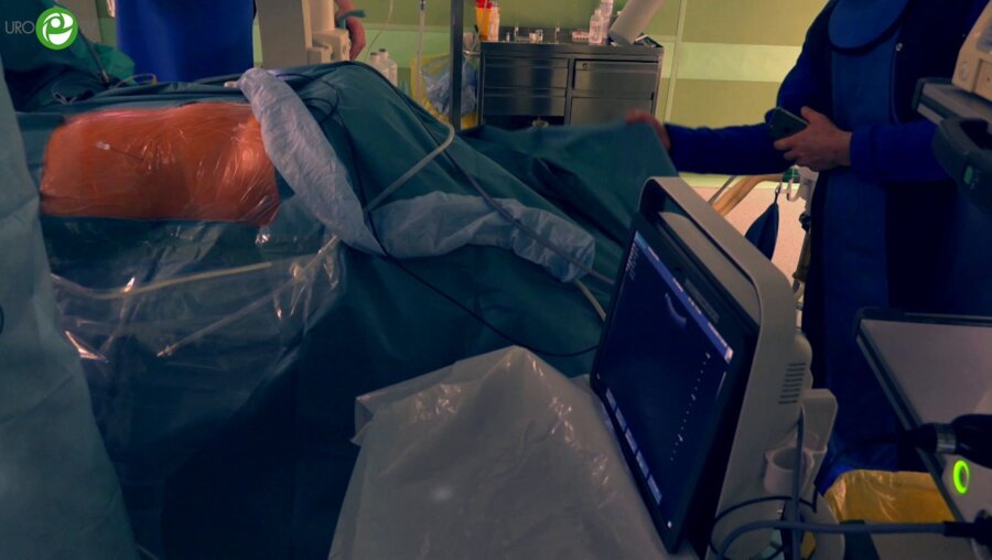 Емельяненко А.В. - ПНЛТ в положении пациента на спине