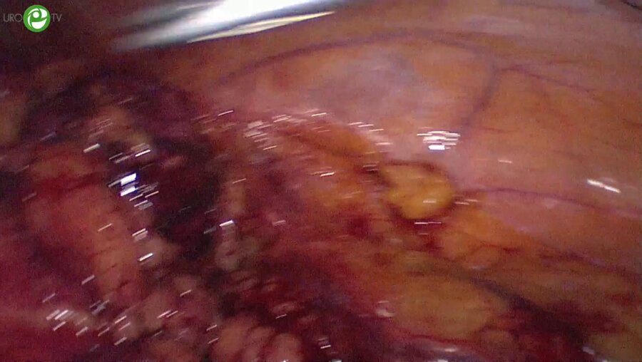 Галлямов Э.А. - Лапароскопическая резекция почки