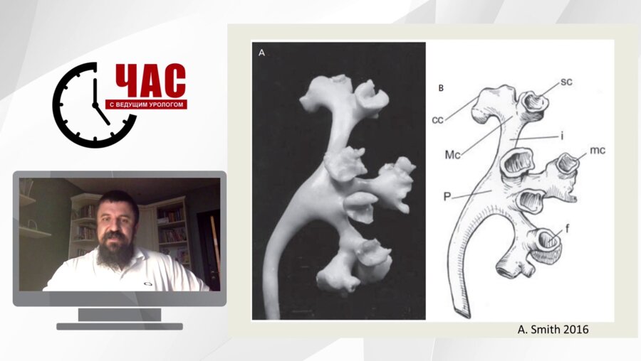 Мазуренко Д.А. - Камни нижней чашечки. Выбор методики и выбор пациентов