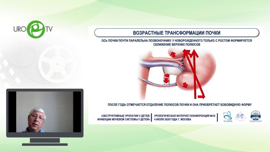 Сизонов В.В.  - Вазоуретеральный конфликт - особенности диагностики и лечения у детей