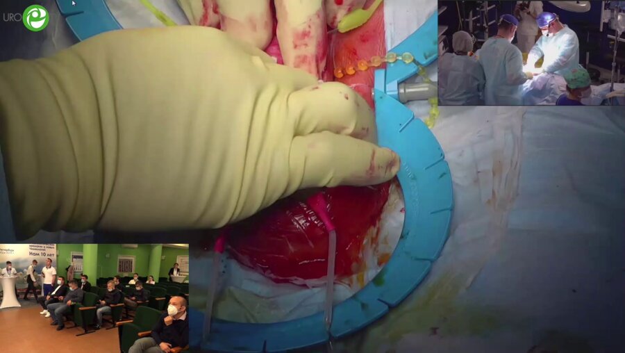 Топузов Т.М. - Фаллопротезирование трехкомпонентным протезом ZSI 475