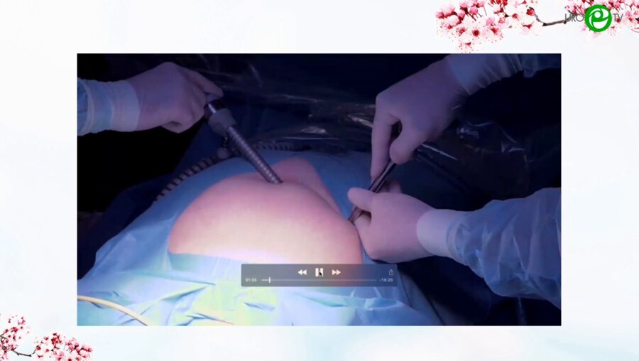 Попов А.А. - Роботическая сакровагинопексия. Москва, операционная МОНИИАГ