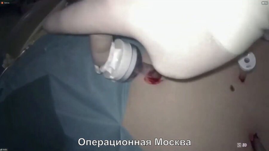 Э.А. Галлямов - Лапароскопическая резекция почки