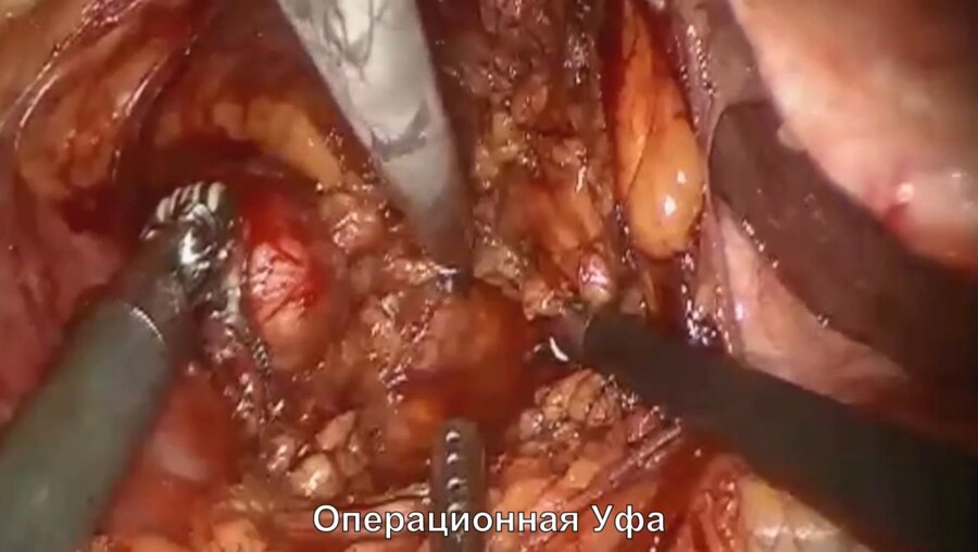 В.Н. Павлов - Робот-ассистированная резекция почки