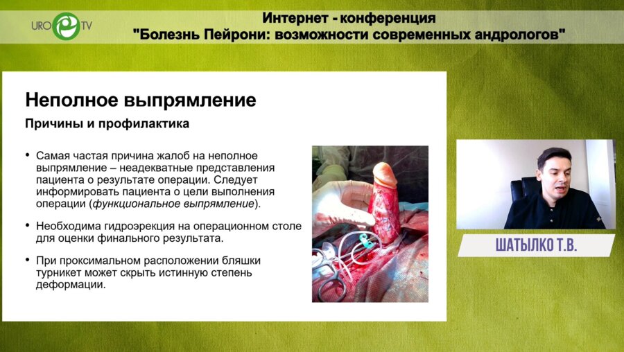 Шатылко Т.В. - Болезнь Пейрони. Хирургические осложнения