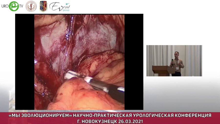 Дианов М.П. - Лапароскопическая лимфодиссекция при раке почки
