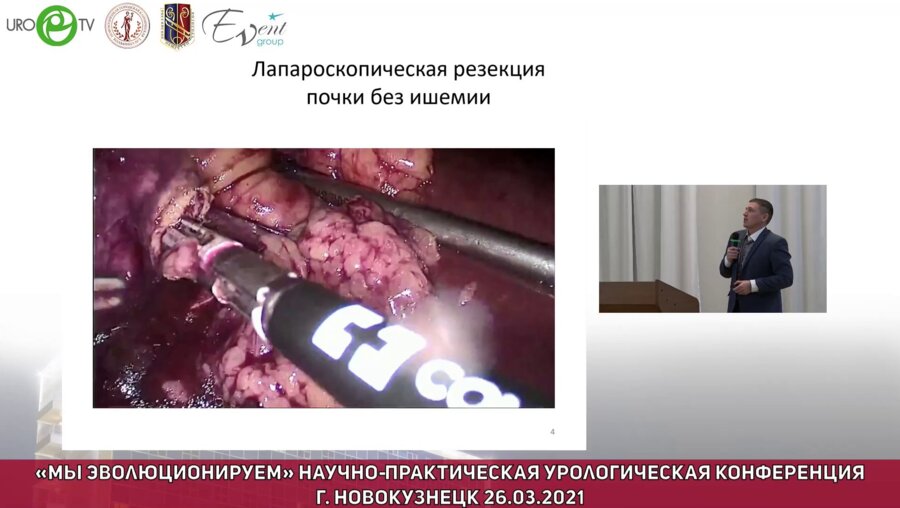 Яловегин А.Д. - Статистика лапароскопических операций. Наш опыт