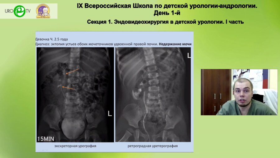Врублевский А.С. - Удвоение верхних мочевых путей у детей - возможности эндоскопической