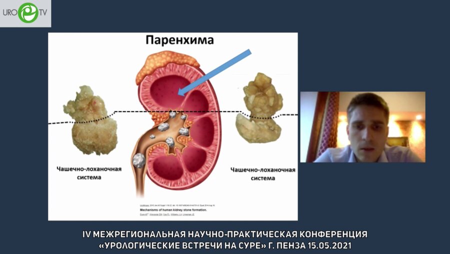 Просянников М.Ю. - Современные возможности метафилактики оксалатного уролитиаза