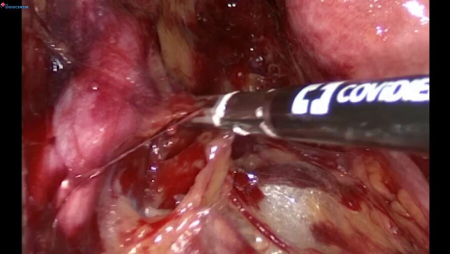 Laparoscopic ant pelvic exenteration, radical cystectomy Bricker