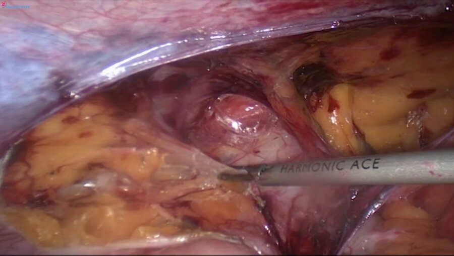Laparoscopic Bilateral TAPP, Harmonic