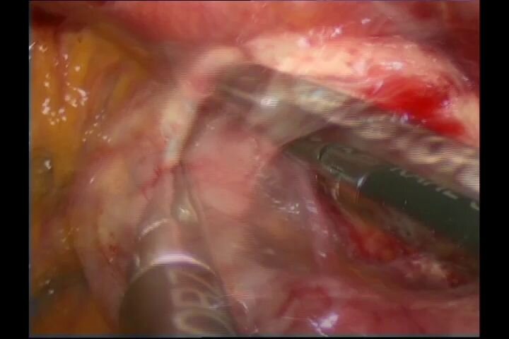 Laparoscopic correction of radiation complications after cervical cancer treatment