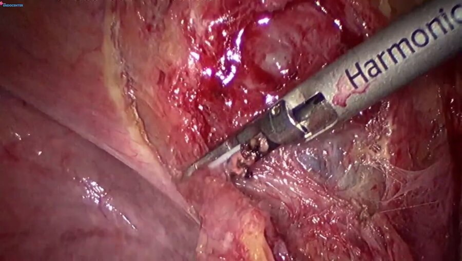 Laparoscopic cystic augmentation LIVE