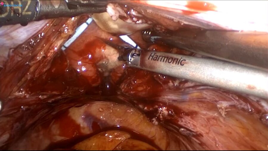 Laparoscopic Cysto-vaginal fistula repair LIVE