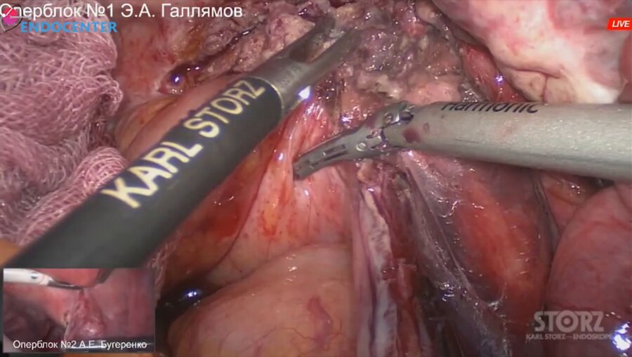 Laparoscopic deep infiltrative endometriosis LIVE (1)
