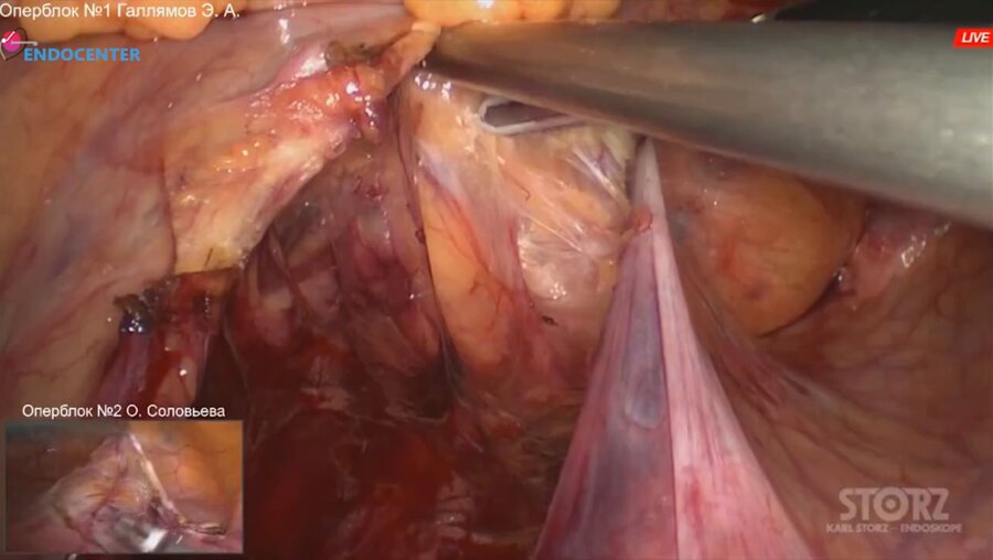 Laparoscopic deep infiltrative endometriosis LIVE