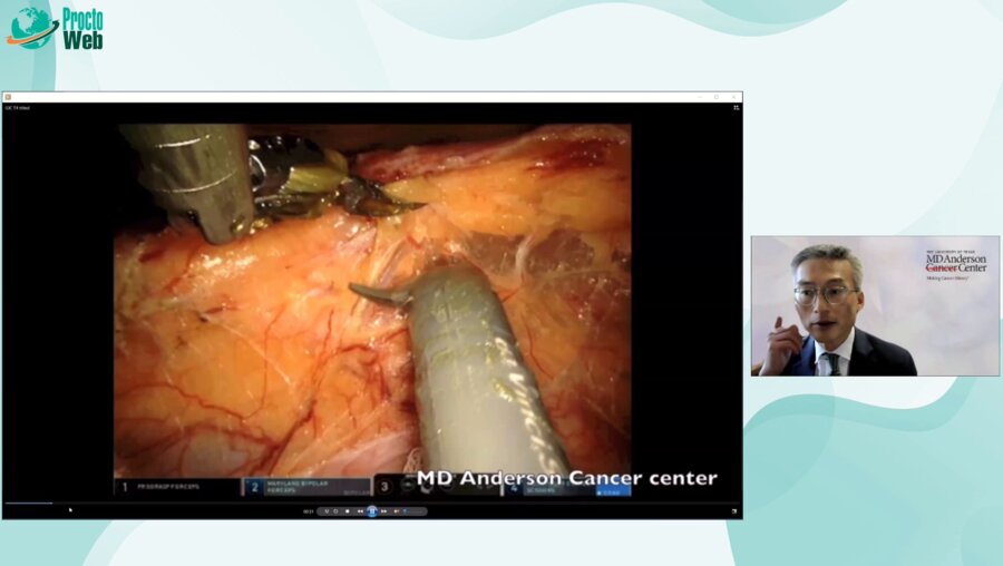 George Chang - Multivesicular Resection for T4 Tumor