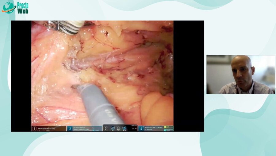 Brain Bednarski - Management of the IMA and splenic flexure mobilixation
