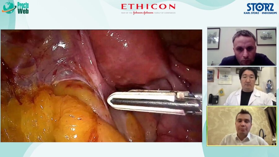 Дивертикулярная болезнь толстой кишки. Выступление Агапова Михаила Андреевича