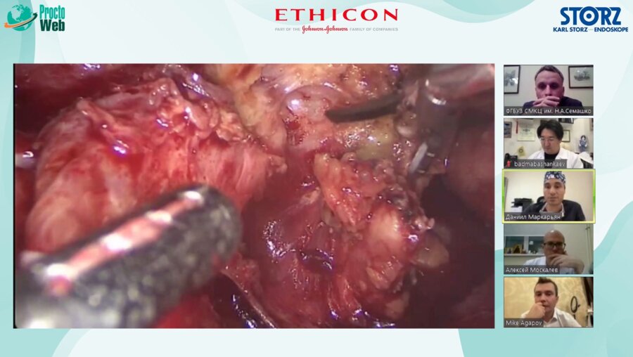 Дивертикулярная болезнь толстой кишки. Выступление Маркарьяна Даниила Рафаэлевича