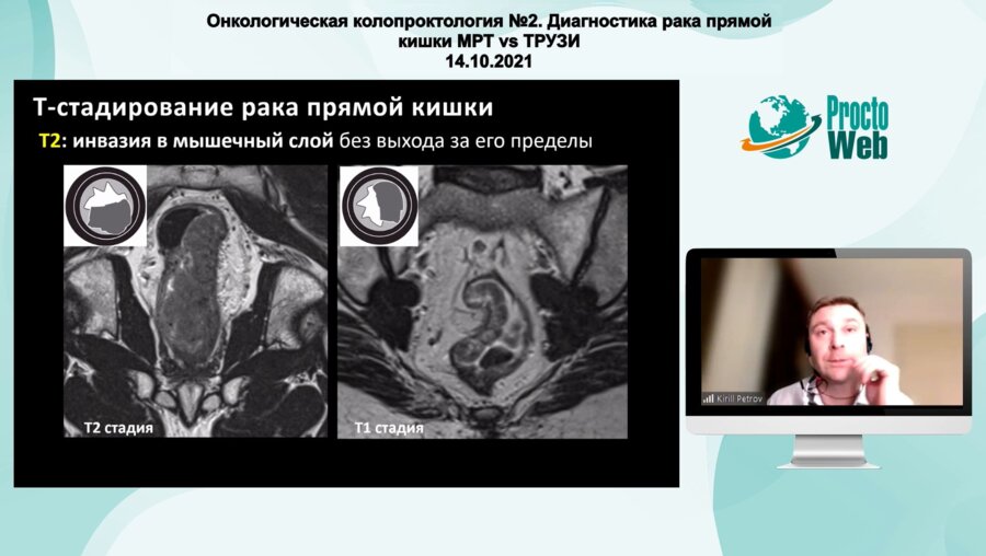 Петров К.С. - МРТ - основы и advanced уровень в диагностике рака прямой кишки
