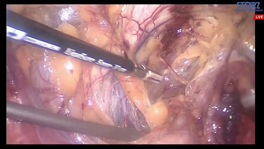 Laparoscopic extraperitoneal radical prostatectomy