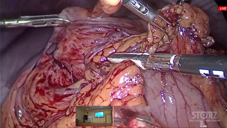 Операция 1. Галлямов Э.Д. - Лапароскопическая крурорафия, фундопликация