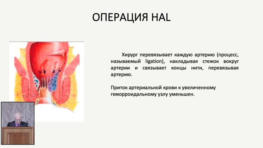 Рязанов Н.В. - Миниинвазивные вмешательства при хроническом геморрое в амбулаторных условиях