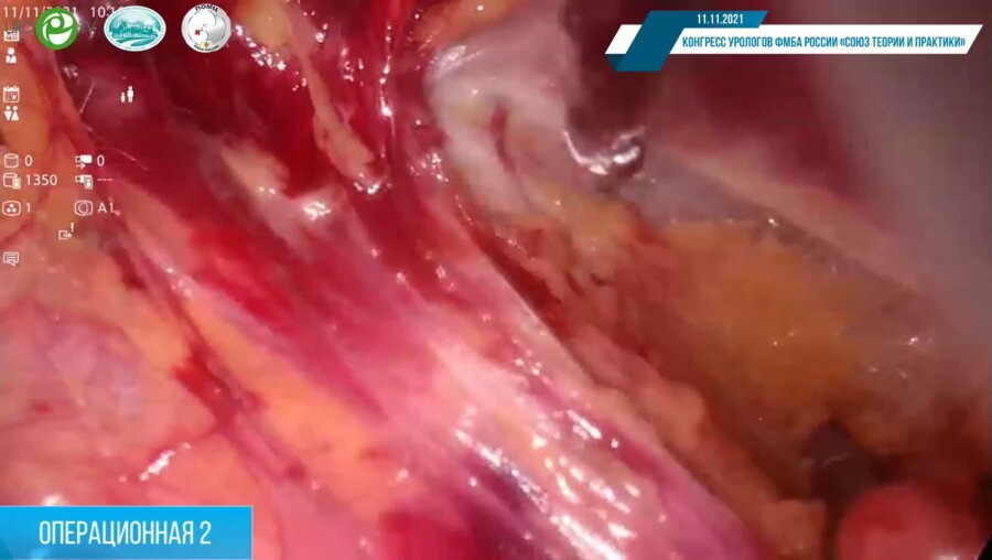 Внебрюшинная радикальная простатектомия с нервосбережением