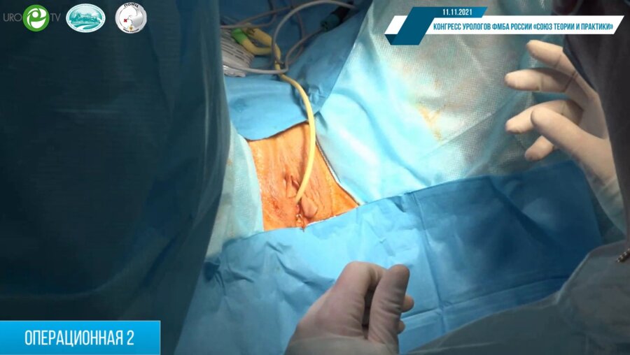 Кызласов П.С. - Пациентка с СНМ