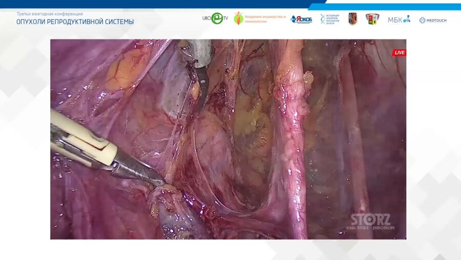 Трансляция из операционной ГБУЗ ЯО Областная клиническая онкологическая больница. Лапораскопическая радикальная трахелэктомия