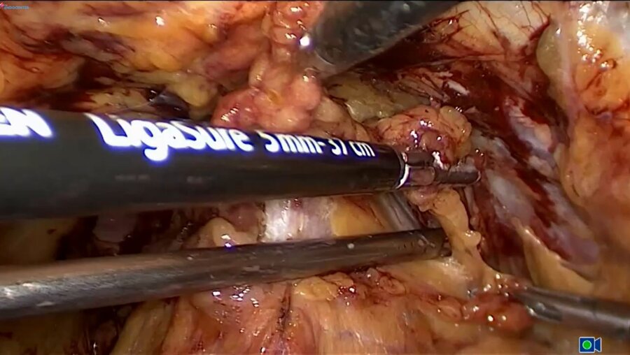 Laparoscopic extraperitoneal radical prostatectomy LIVE