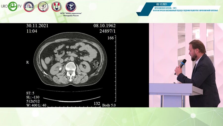 Меринов Д.С. - Фиброуретеропиелолитотрипсия