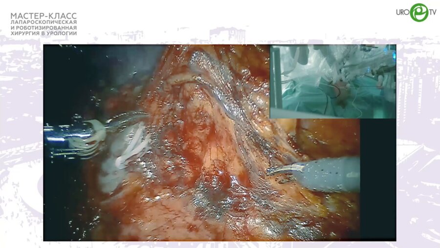 Мосоян М.С. - Робот-ассистированная резекция почки с опухолевым узлом. RENAL 10