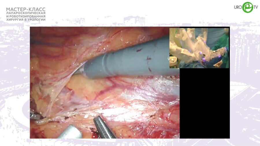 Медведев В.Л. - Робот-ассистированная пластика ретрокавально расположенного мочеточника